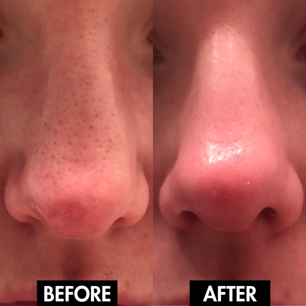 Lunoox™ Electric Facial Pore Vacuum (+ FREE Mystery Gift)