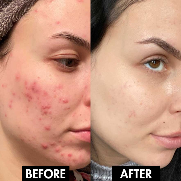 Lunoox™ Electric Facial Pore Vacuum (+ FREE Mystery Gift)
