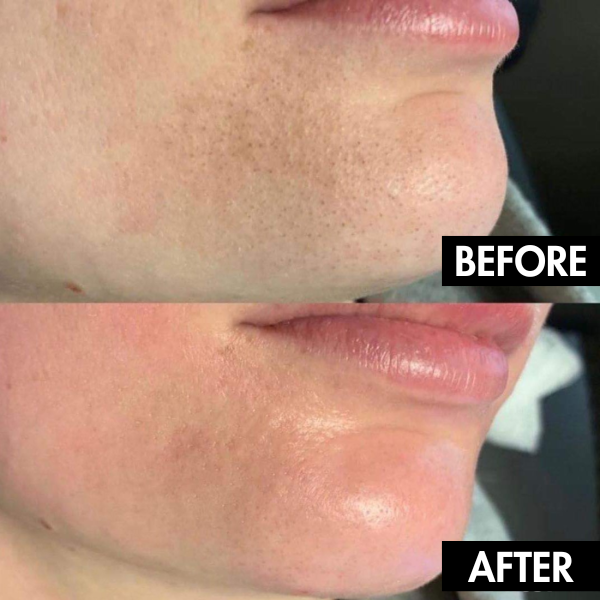 Lunoox™ Electric Facial Pore Vacuum (+ FREE Mystery Gift)