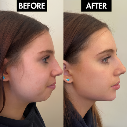 Lunoox™ Jaw & Chin Lifting Mask
