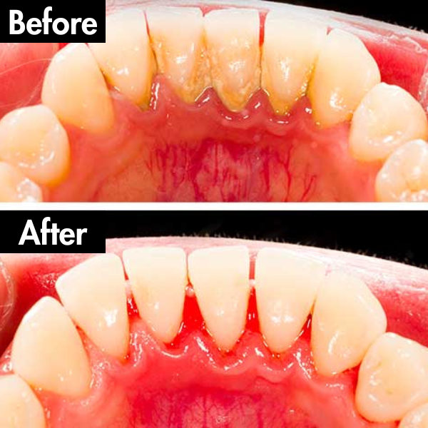 Lunoox™ Electric Tartar Remover