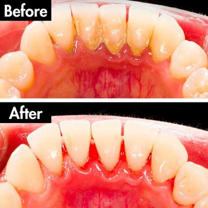 Lunoox™ Electric Tartar Remover