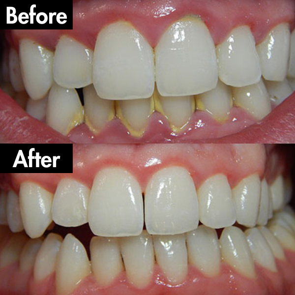 Lunoox™ Electric Tartar Remover