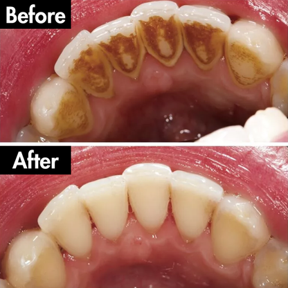 Lunoox™ Electric Tartar Remover