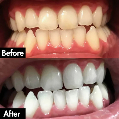 PurelyWhite™ Teeth Whitening Strips by Lunoox