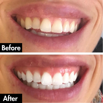 PurelyWhite™ Teeth Whitening Strips by Lunoox