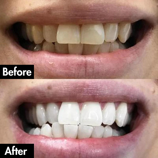 PurelyWhite™ Teeth Whitening Strips by Lunoox