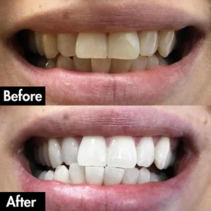 PurelyWhite™ Teeth Whitening Strips by Lunoox