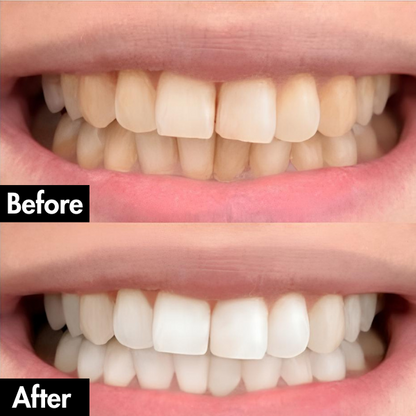 PurelyWhite™ Teeth Whitening Strips by Lunoox