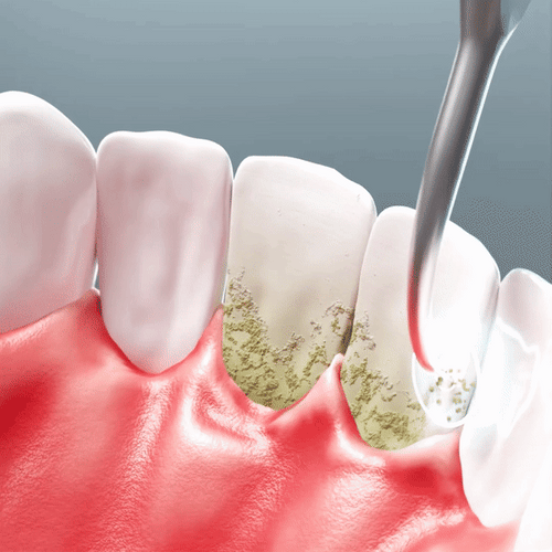 Lunoox™ Electric Tartar Remover