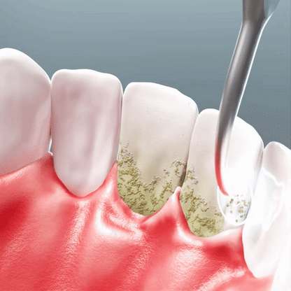 Lunoox™ Electric Tartar Remover